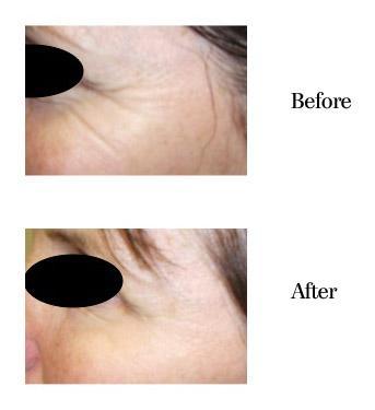 Before and After BOTOX® Cosmetic in Sarasota FL