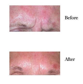 Before and After BOTOX® Cosmetic Treatment in Bradenton FL