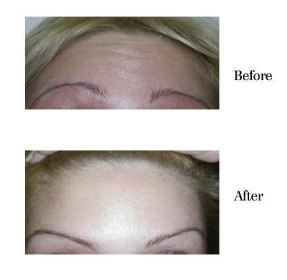 Before and After BOTOX® Cosmetic in Bradenton FL