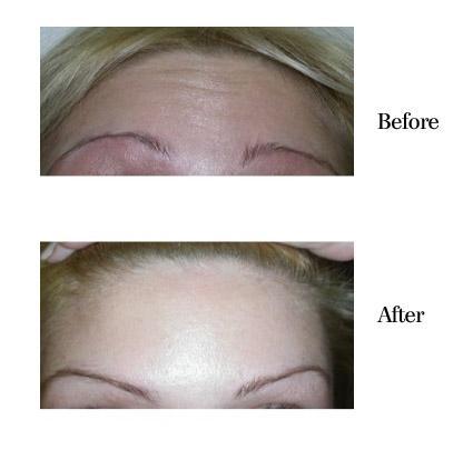 botox treatment sarasota fl