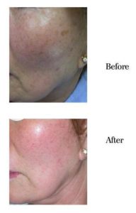 IPL Photo rejuvenation sarasota fl