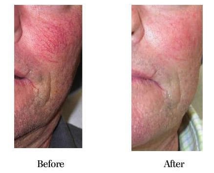 Before and After Laser Skin Resurfacing in Sarasota FL