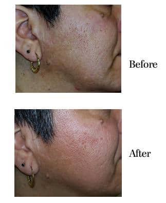 Before and After Laser Skin Resurfacing in Bradenton FL