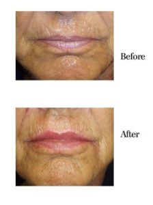 Before and After Dermal Fillers in Sarasota FL