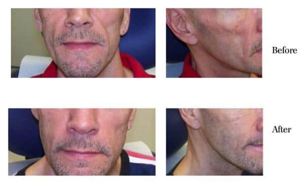 man before and after sculptra with less wrinkles after treatment