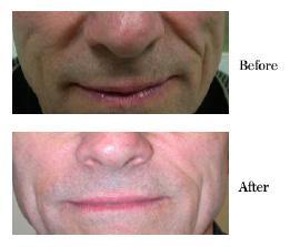 Before and After Dermal Fillers Treatment in Sarasota FL