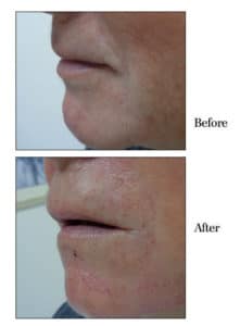 Before and After Dermal Fillers in Bradenton FL