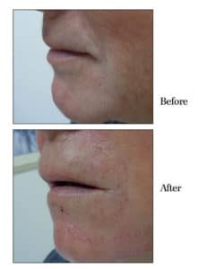 Face Filler before and after sarasota, fl