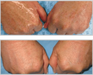 Before & After BBL Therapy in Sarasota FL