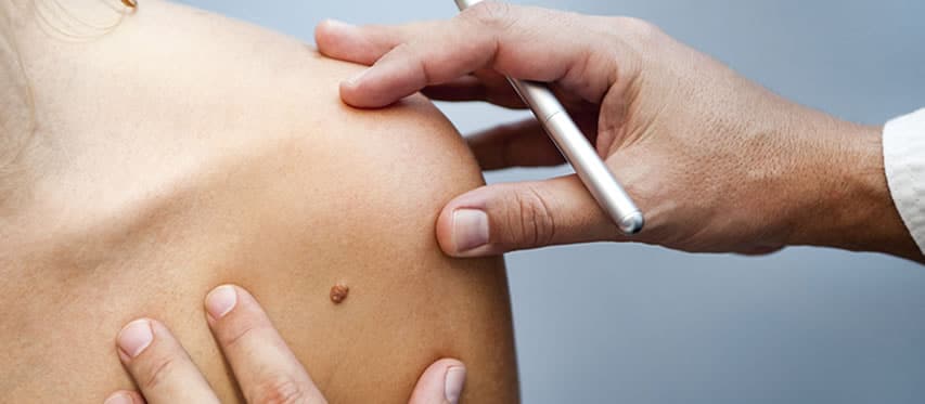 up close of dermatologist holding scalpel in one hand observing mole on patient's arm