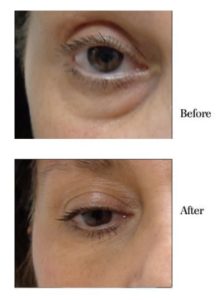 juvederm sarasota, fl
