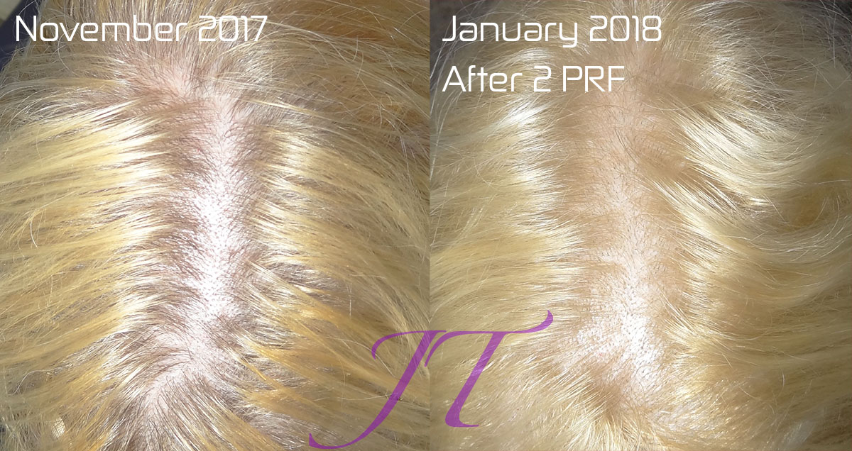Hair Loss Treatment in Sarasota | Hair Regrowth with PRF