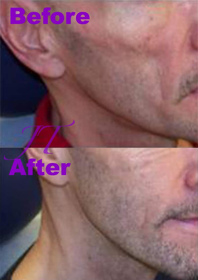 Sculptra® Injections in Sarasota, FL | American Dermatology Associates