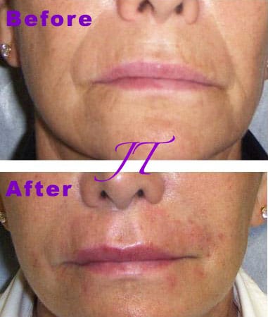 Before and After Restylane in Bradenton FL