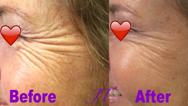 Botox