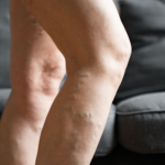 Laser vein treatment