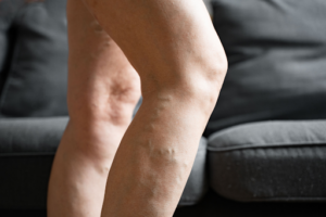 Laser vein treatment