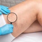 A doctor holding a magnifying glass over a patient’s leg veins