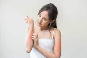 A woman with eczema scratching her arm