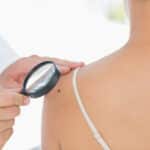 Small mole on a woman's shoulder being checked for melanoma by a dermatologist.