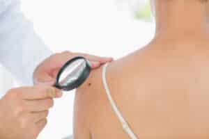Small mole on a woman's shoulder being checked for melanoma by a dermatologist.