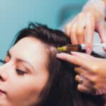 PRF injections into the hairline are a good way to stimulate hair growth in Sarasota, FL