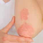 Examining psoriasis on a woman's elbow, warranting dermatologic care.