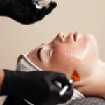 Provider applies a chemical peel to a patient’s face during treatment for sun-damaged skin.