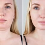 Woman addresses her double chin with Kybella injections.