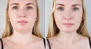 Woman addresses her double chin with Kybella injections.